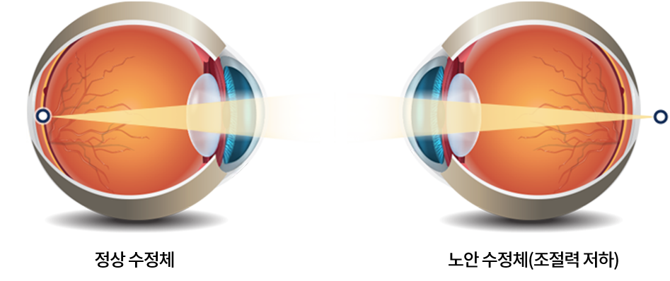 cataract_1row_01(수정)