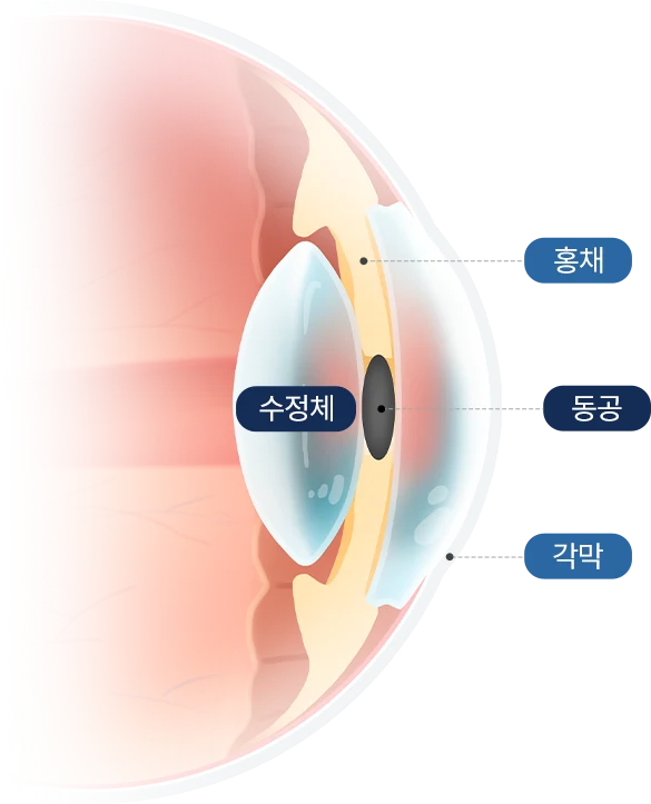 cataract_3row_01