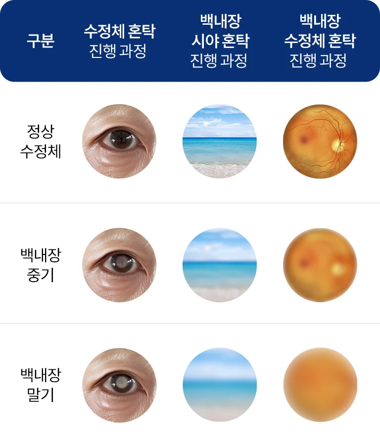 cataract_6row_02수정3